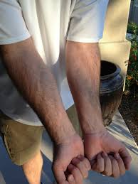 Issue With Arm Pump Moto Related Motocross Forums Message Boards Vital Mx