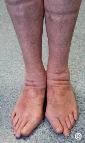 Image result for Pigment stains on the shin