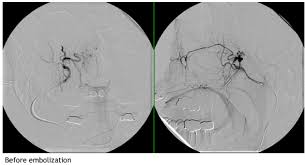 Image result for Epistaxis