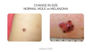 Common warning signs of melanoma are changes in color, size, and shape of skin/moles, new growth areas on the skin, and sores that do not heal. Melanoma Pictures Skin Melanomas Vs Non Cancerous Moles