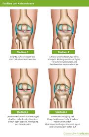 Eines der häufigsten krankheitsbilder bei knieschmerzen von radsportlern ist die chondropthia patellae, eine knorpelveränderung an der kniescheibenrückseite. Arthrose Anzeichen Ursachen Behandlung Der Volkskrankheit