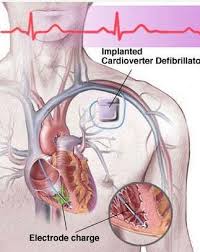 An icd is a small device which can treat people with dangerously abnormal heart rhythms. Automated Implantable Cardioverter Defibrillator Services à¤¡ à¤« à¤¬ à¤° à¤² à¤Ÿà¤° Konkan Cardiac Centre Ratnagiri Id 14309608791