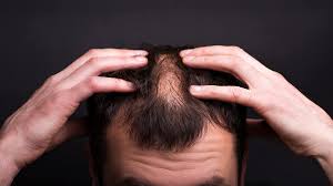 As we discussed above, miniaturization of the hair follicles and the premature termination of the anagen (growth) phase of hair are the primary. Special Features Saving Money On Prescription Medication For Hair Loss