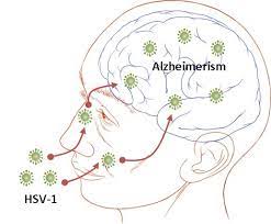 I think it says a lot about herpes, that if i had one wish it wouldn't be to rid myself of this virus. Herpes In The Brain Gaining Recognition As A Possible Etiological Agent In Alzheimer S By Shin Jie Yong The Startup Medium