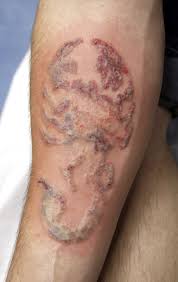 Eyebrow shaping, hair treatments, hair restoration, laser hair removal, microdermabrasion, medical dermabrasion, medical dermatology, chemical peel, laser skin treatment, botox, tattoo removal, plastic surgery. Think Before You Ink Tattoo Removal Costly Long Painful Richmond Com