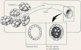 It's more of a precancer, or preinvasive lesion. Ductal Carcinoma In Situ Dcis Dr Susan Love Foundation For Breast Cancer Research