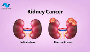 3 ﻿ these may be signs your cancer has spread to your spine or your liver, respectively. Kidney Cancer Symptoms Causes Diagnosis Treatment Nu Hospitals