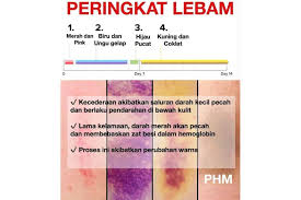 Warna merah, biru, dan hijau adalah warna dasar untuk cahaya, sedangkan warna merah, kuning, dan biru adalah warna dasar untuk benda. Kesan Lebam Berubah Jadi Kuning Kenali Warna Lebam Bahayanya