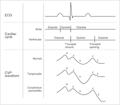 In such cases of cardiac tamponade, ekg or holter monitor will then depict electrical alternans indicating wobbling of the heart in the fluid filled pericardium, and the capillary refill might decrease. Inflammatory Heart Disease Pericardial Effusion And Tamponade Pericarditis And Myocarditis Sciencedirect