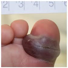 Image result for Dactylitis