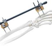 Small External Fixation System | Products | DePuy Synthe