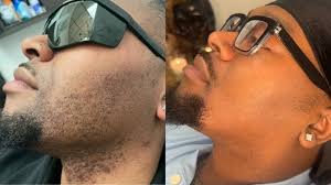 L.A.C.I. (@laser_aesthetics_institute) · Atlanta, GA