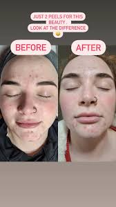 How peels help breakout skin :, 1. Exfoliation: Peels help remove dead skin  cells from the surface, which can clog pores and contribute to breakouts.  By exfoliating the skin, peels can prevent new ...