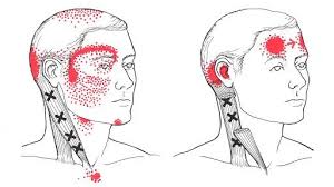 Image result for Trigger Point Injection