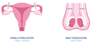 Although vasectomy reversals are possible, vasectomy should be considered a permanent form of male birth control. Vasectomy Expectations And Effectiveness Menmd