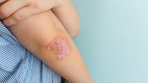 Image result for ringworm