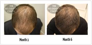 Excessive or abnormal hair loss is known as alopecia, and there are several kinds. What Is Male Pattern Baldness