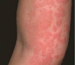 Pin On Celiac Disease