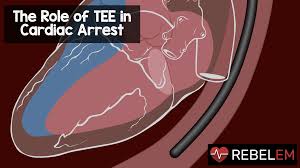 The overall survival from cardiac arrest, especially unwitnessed, is poor and, among early survivors, is fraught with. The Role Of Tee In Cardiac Arrest Rebel Em Emergency Medicine Blog