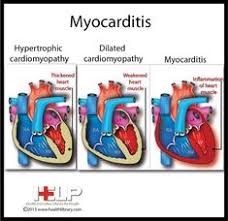 In both cases, the body's immune system causes inflammation in response to an infection or some other trigger. 36 Myocarditis Ideas Inflammation Of The Heart Heart Muscle Rheumatic Fever