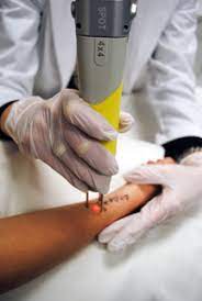 The lasers used for tattoo removal emit a pulsing light energy that can penetrate the upper layers of the skin. Tattoo Removal Laser Equipment Buying Guide From Astanza