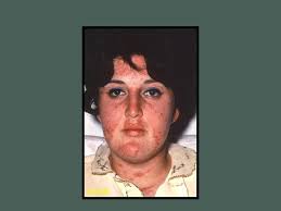 OVERVIEW: WHAT IS FIBROMYALGIA