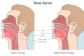 The two main types of sleep apnea and how to treat them