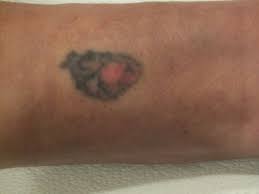 Lana and diana have been removing tattoos successfully for over 6 years with oregon aesthetics and laser tattoo removal. Before After Oregon Aesthetics Laser Tattoo Removal Oregon Aesthetics Laser Tattoo Removal