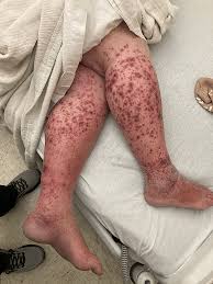 Image result for Vasculitis