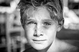 The food and drug administration (fda) approves minoxidil to treat hair loss. Why Is Your Teen Suffering From Hair Loss Custom Hair Tampa Bay