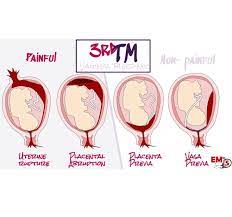 The internet is full of stories about teen pregnancy that offer a variety of perspectives on coping with the sometimes difficult dilemma. Third Trimester Vaginal Bleeding Em In 5