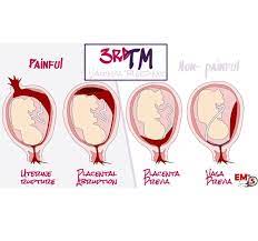 Light bleeding, or spotting, during pregnancy is common, especially during the first trimester. Third Trimester Vaginal Bleeding Em In 5