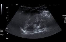 Duplex Collecting System Radiology Case Radiopaedia Org