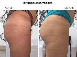 Medical camouflage for stretch marks is a tattooing method in which stretch marks are camouflaged with different color pigments. Have You Heard About Cosmetic Tattoo Concealer
