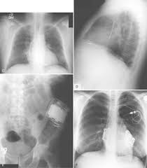 Cxr pacemaker non icd vs icd. Imaging Of Implantable Devices Clinical Gate