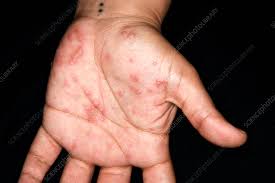 Image result for Pustular Psoriasis