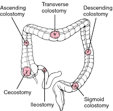 Stoma Definition Of Stoma By Medical Dictionary Medical Dictionary Surgical Nursing Nursing School