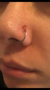 Need Help Identifying Type Of Bump On Nose Piercing 2 Months Old Originally Pierced With Titanium Stud Was Healing Well Then Told Incorrectly I Was Fine To Swap Jewelry If No Pain