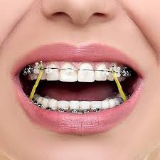 1Box 5000Pcs Orthodontic Elastic Band Soft/Medium/Heavy Transparent Light  Yellow - Aliexpress