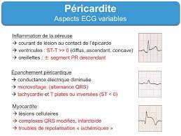 Ondes t plates entre la 24e et la 48e heure ; Pericardite Aigue 1 Typique E Cardiogram