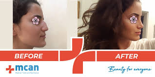 What Is The Perfect Nose Shape Rhinoplasty Mcan Health perfect nose shape rhinoplasty