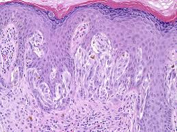 Image result for Spitz Nevus