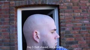 Some men start to lose hair on the head and it's an embarrassment having big bald patches, they try to disguise this by shaving the whole head. Shr Laser Hairremoval On Head 2 Treatment Beauty Hair Nail Skin Tutorials