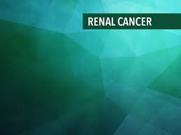 Compared to never smokers there is a 50% increased risk in male and 20% increased risk bun and creatinine: Treatment Of Stages I Iii Kidney Cancer Cancerconnect