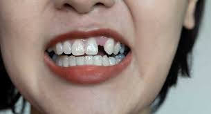 Snaggletooth | Crooked Tooth | Misaligned Tooth