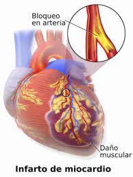 O infarto agudo do miocárdio (iam), também conhecido como infarto ou ataque cardíaco, corresponde à interrupção da passagem de sangue para o coração, o que provoca a morte das células cardíacas e causa sintomas como dor no peito que pode irradiar para o braço. Infarto Agudo De Miocardio Wikipedia La Enciclopedia Libre