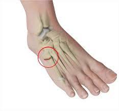 fractures of the 5t metatarsal bone كسور العظمه الخامس لمشط القدم الدكتور مازن كردية