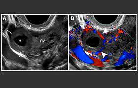 Image result for corpus luteum sonography)