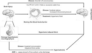 Image result for Hypernatremia