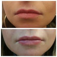 Amalian soft filler makes a fast and uncomplicated wrinkle treatment possible. 1ml Of Amalian 24 Lip Fillers 180 Kalaira S Hair And Beauty Facebook